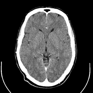 Scans of the human brain using computerised tomography techniques have shown physical changes in the brains structure in many people with schizophrenia (Photo: Uppsala University Hospital on Wikimedia Commons)